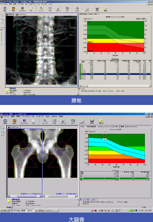 骨粗鬆症・骨密度測定データ